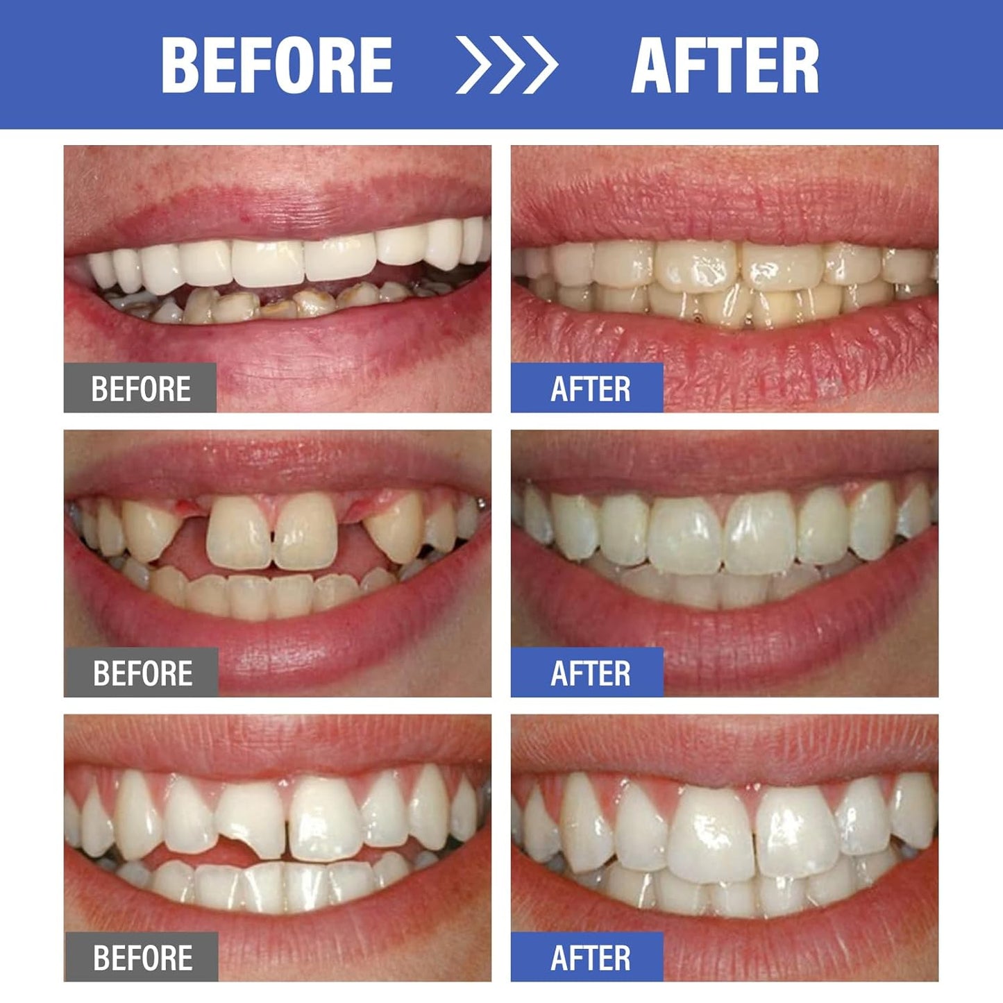 🦷✨Dientes Temporales En Resina✨🦷